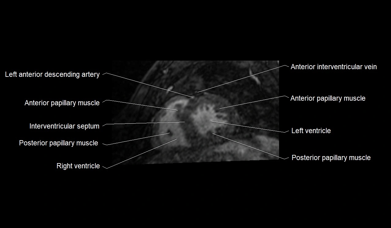 MRI heart and coronary arteries short axis anatomy image 29.webp